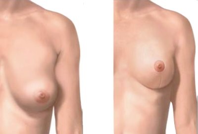 Chirurgie mammaire : ptôse et lifting des seins