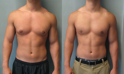 gynecomastie tunisie