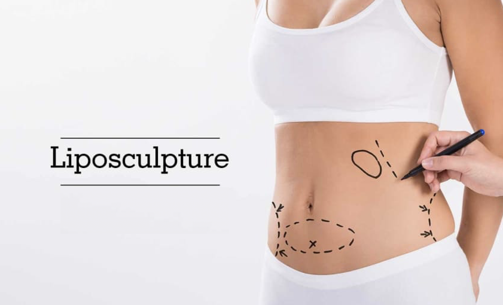 Liposculpture