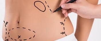 lipoaspiration-tunisie